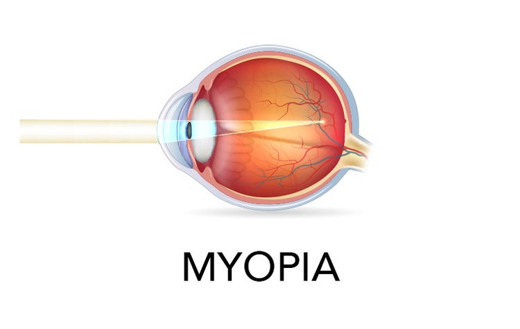 Myopia